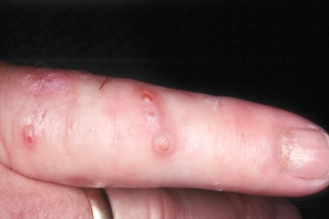 Is Dermatitis Contagious