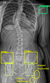 Skeletal Maturity