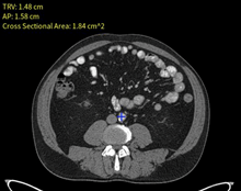 Aortic Aneurysm AI