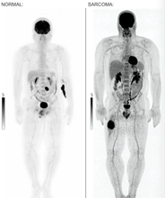 Thigh Sarcoma AI