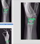 Wrist Bone
