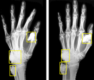 Calcification