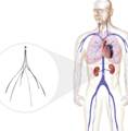 IVC Filter