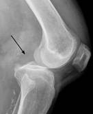 NLP QA Fractures