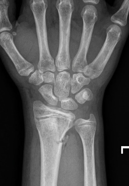 Wrist fracture AI