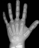 Hand bone age AI
