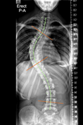 Scoliosis AI