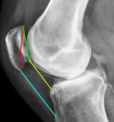 Knee Patella Malalignment