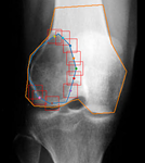 Bone Tumor Precision