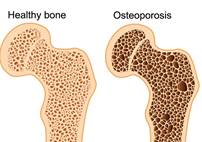 NLP QA Osteoporosis