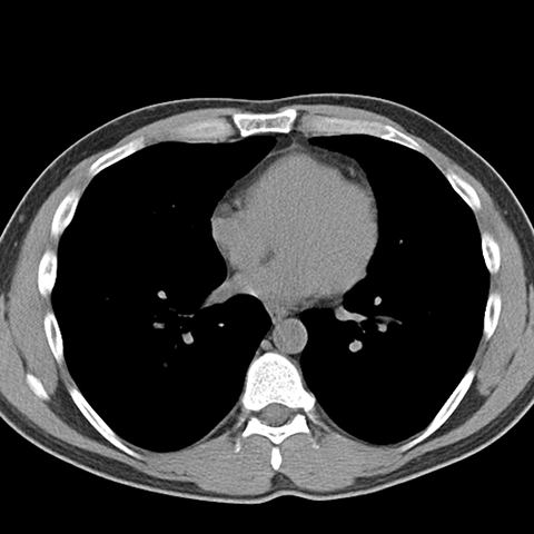 Normal Unenhanced CT (Mediastinal Window) [7 of 8]