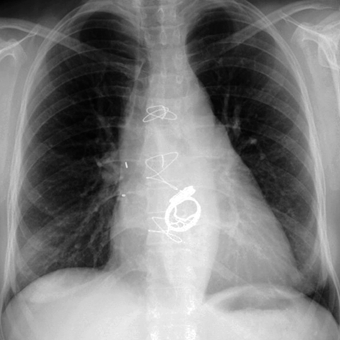 Prosthetic Aortic & Mitral Valves (PA CXR) [4 of 5]