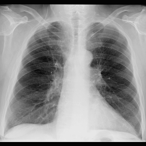 Subtle LLL Retrocardiac Opacity (CXR) [1 of 2]