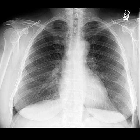 PA of Normal Trachea and Bronchi [1 of 5]