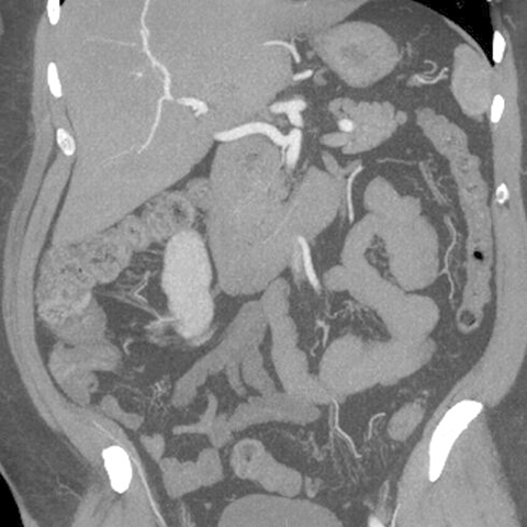 Normal Appendix, CT (coronal) [3 of 6]