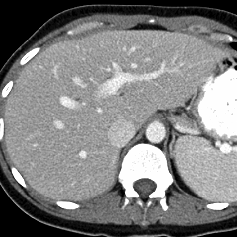 Normal Liver, CT ( axial ) [3 of 9]