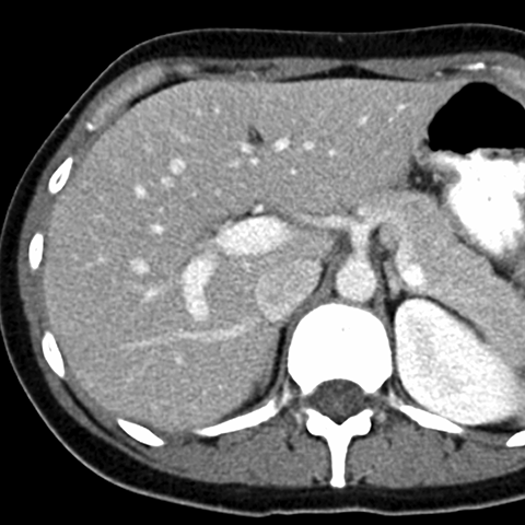 Normal Liver On Ct Scan