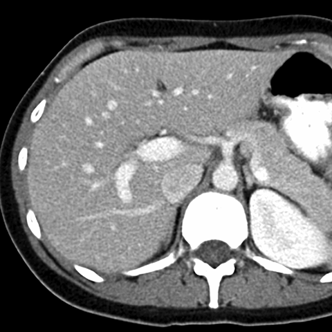 Normal Liver, CT ( axial ) [6 of 9]