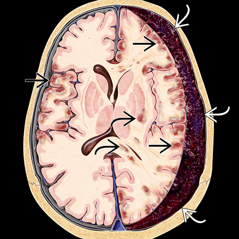 Subdural Hematoma Years Later Maternity Photos | Sexiz Pix