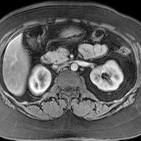 Normal Pancreas, Axial MRI [3 of 3]